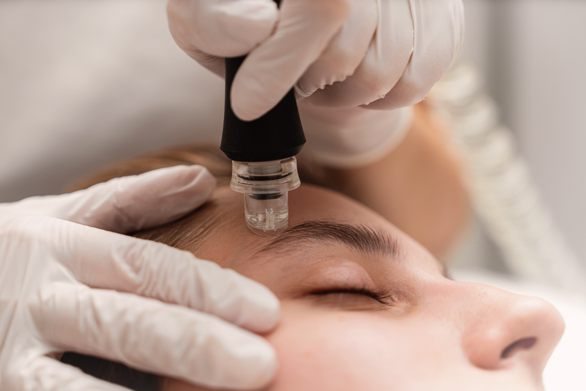 Microneedling